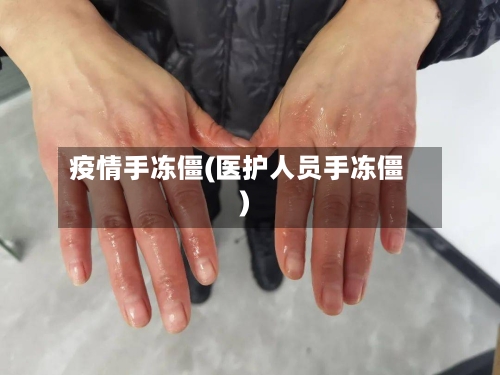 疫情手冻僵(医护人员手冻僵)-第2张图片